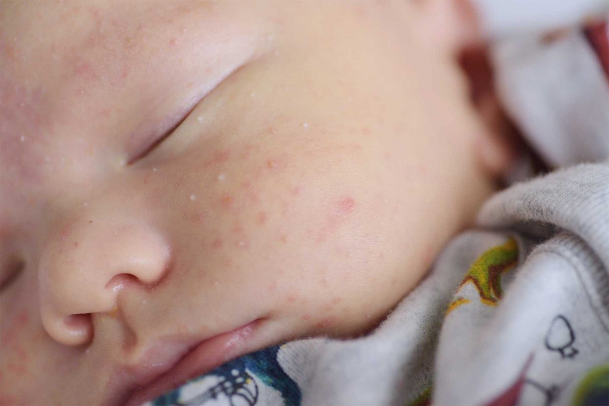 Acne neonatale: una fase normale della pelle