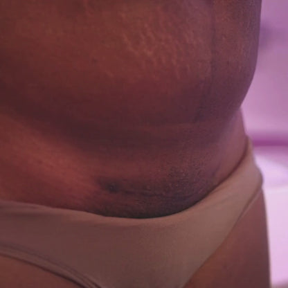 Cerotti Frida Mom in silicone medicale per cicatrice da parto cesareo (6 pezzi)